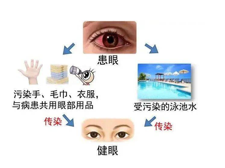 預(yù)防“紅眼病”，呵護(hù)眼健康——?？谑猩礁哂變簣@急性結(jié)膜炎預(yù)防知識(shí)宣傳活動(dòng)-圖片21
